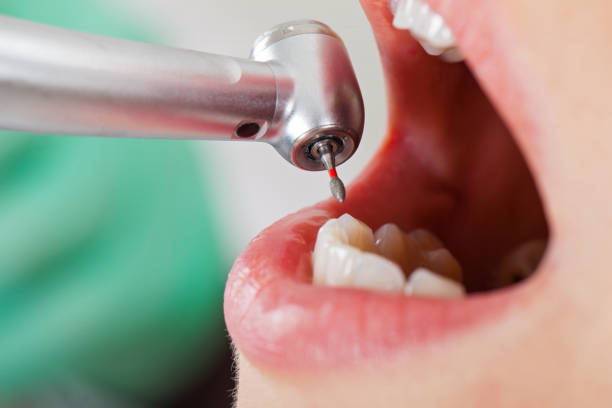 Best Lost Filling or Crown Replacement in Kenilworth, PA